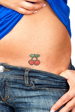 Tattoo Removal Longmont Cherry Girl